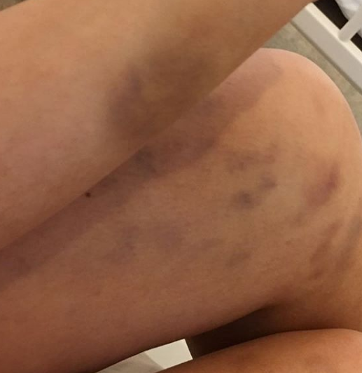 Stephanie Davis bruises