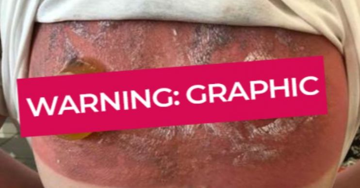 Sunburn graphic warning