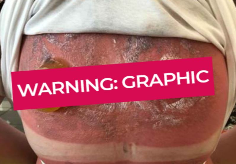 Sunburn graphic warning