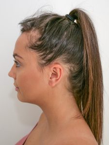 Tyla Carr hair loss
