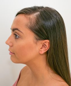 Tyla Carr hair loss