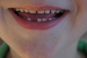 Child missing a tooth