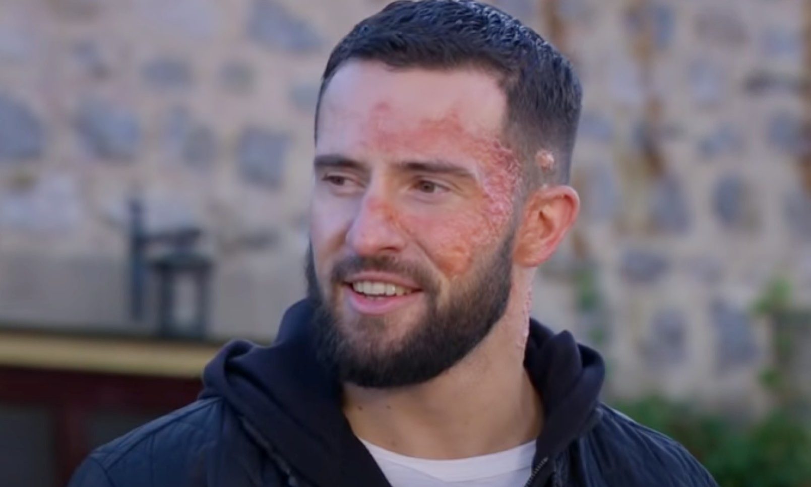 Ross Barton with scar on his face in Emmerdale