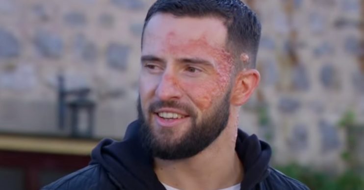 Ross Barton with scar on his face in Emmerdale