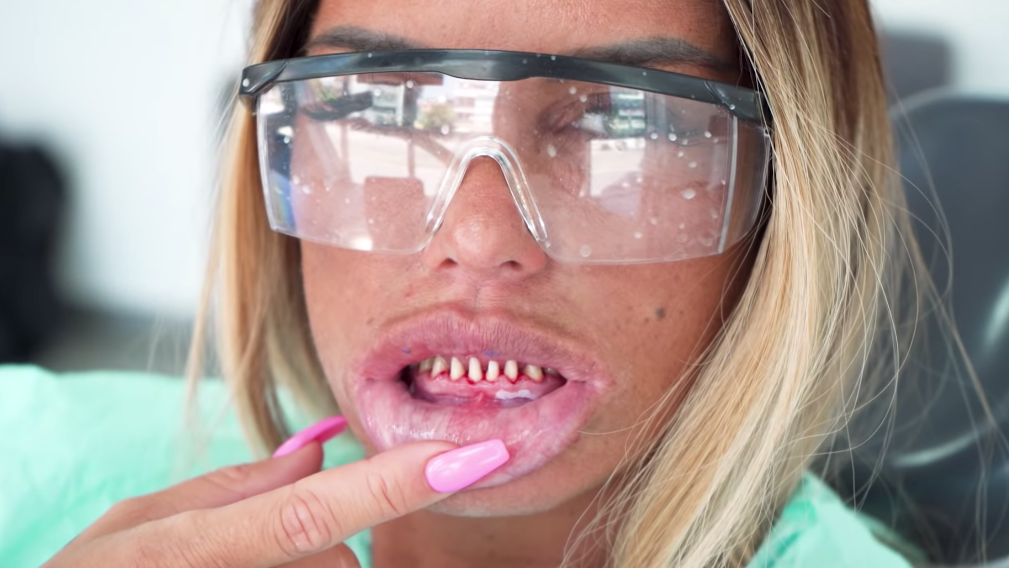 Katie Price teeth