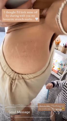 Stacey Solomon stretch marks