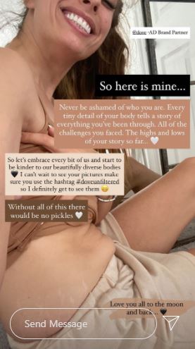 Stacey Solomon stretch marks