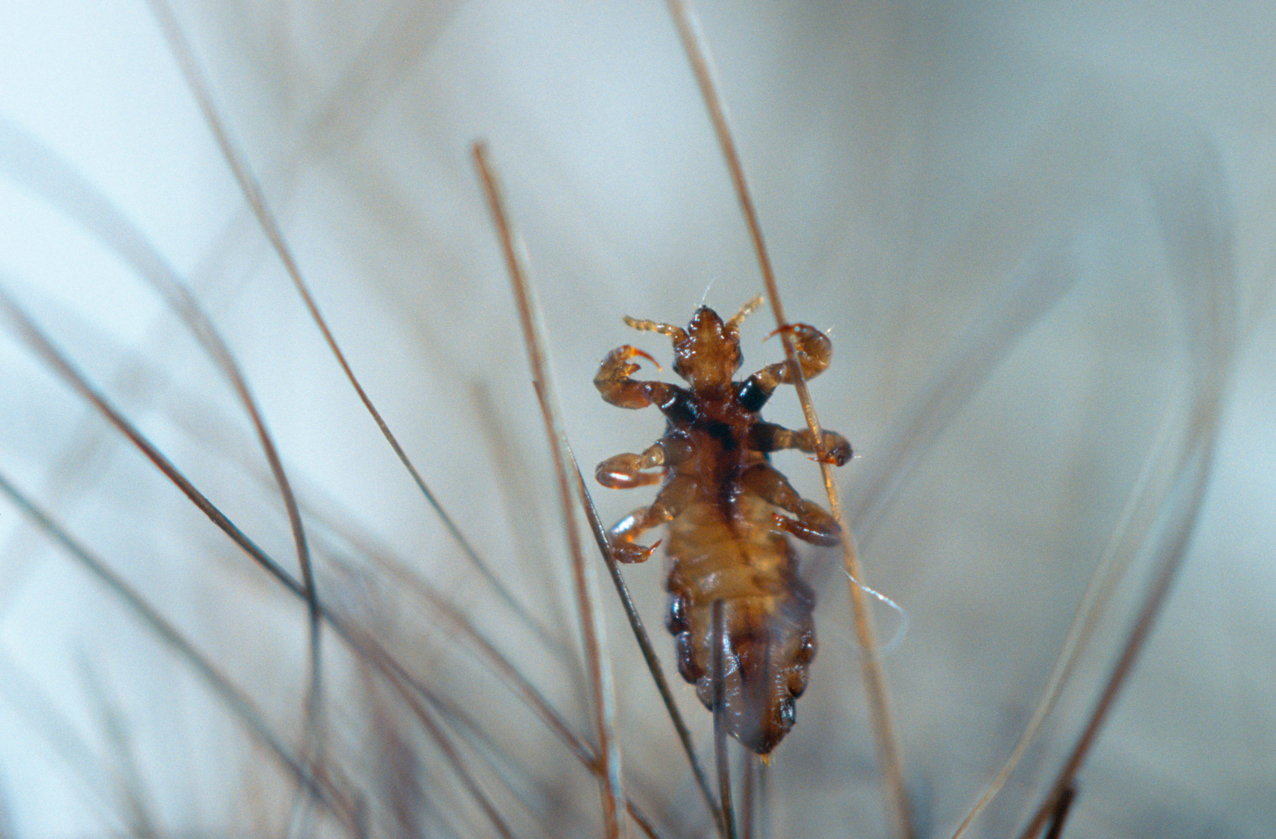 head lice