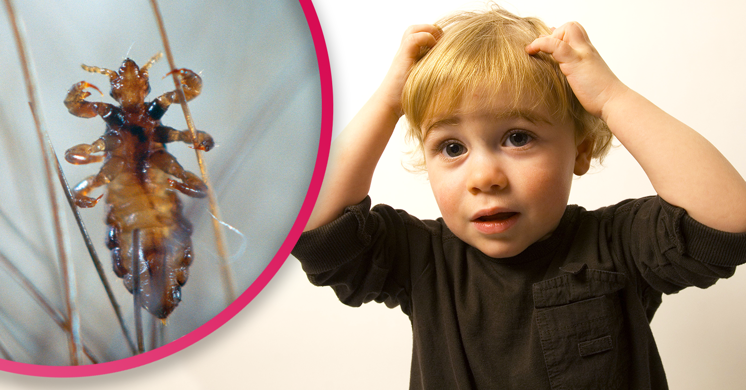 head lice