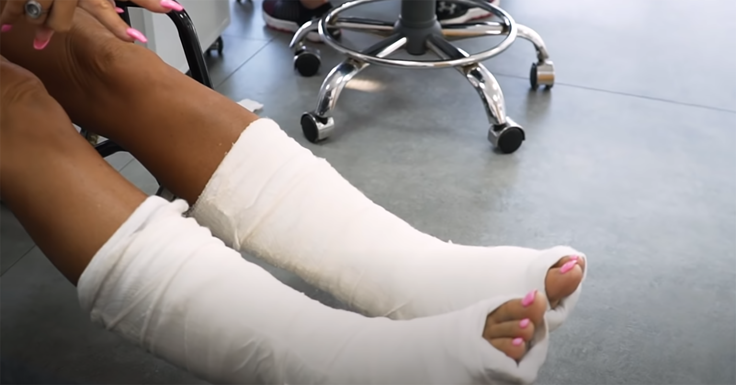 Katie Price breaks feet