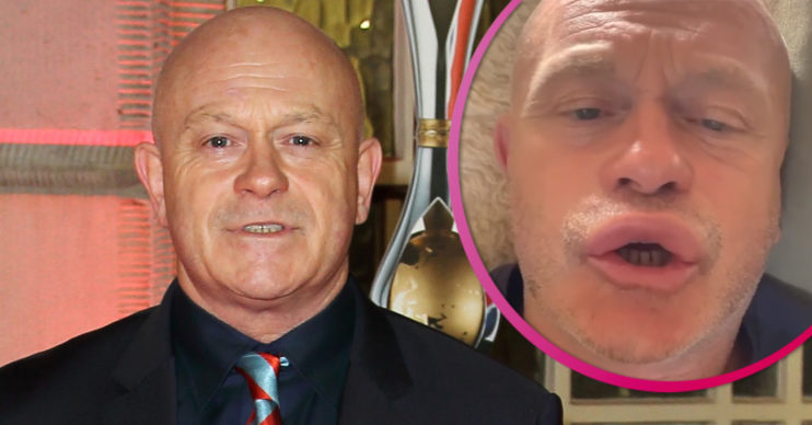 Ross Kemp wasp sting
