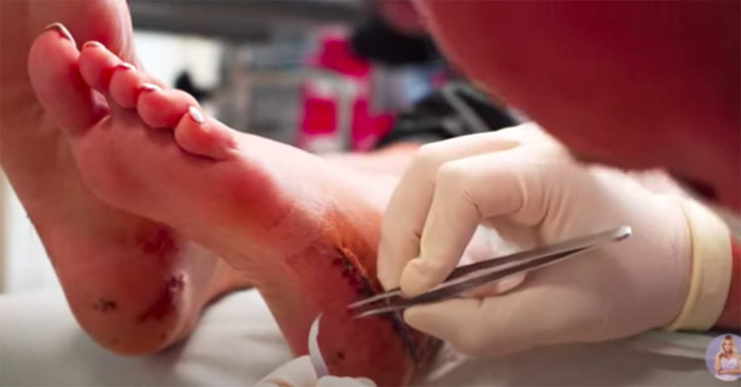 katie price stitches