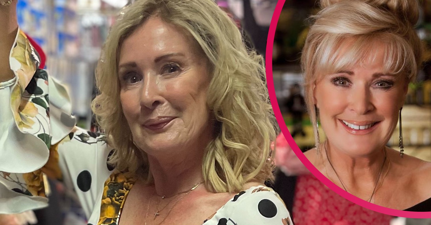 Beverley Callard cosmetic surgery