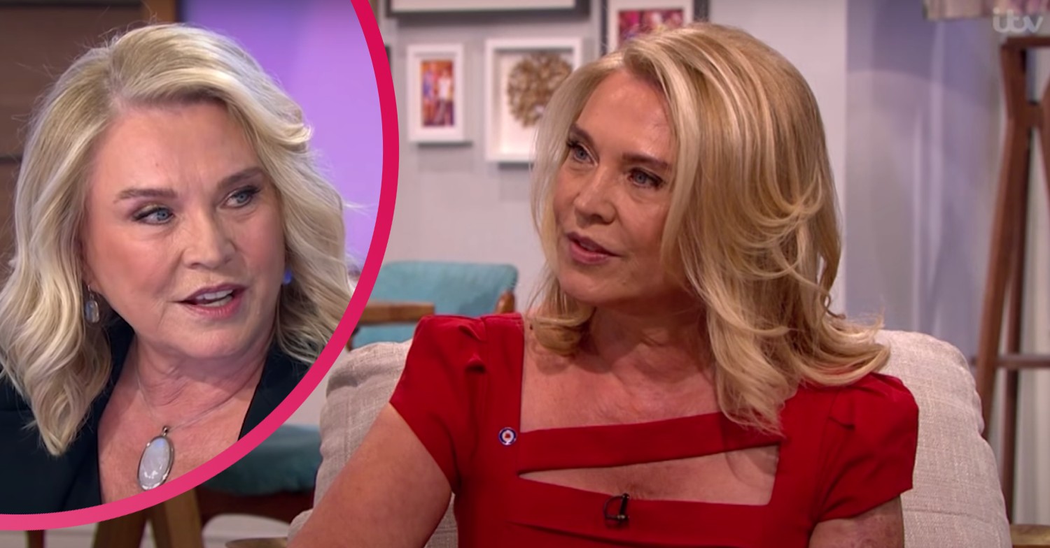 Good Karma Hospital Amanda Redman on how she was left with burns scars following childhood trauma