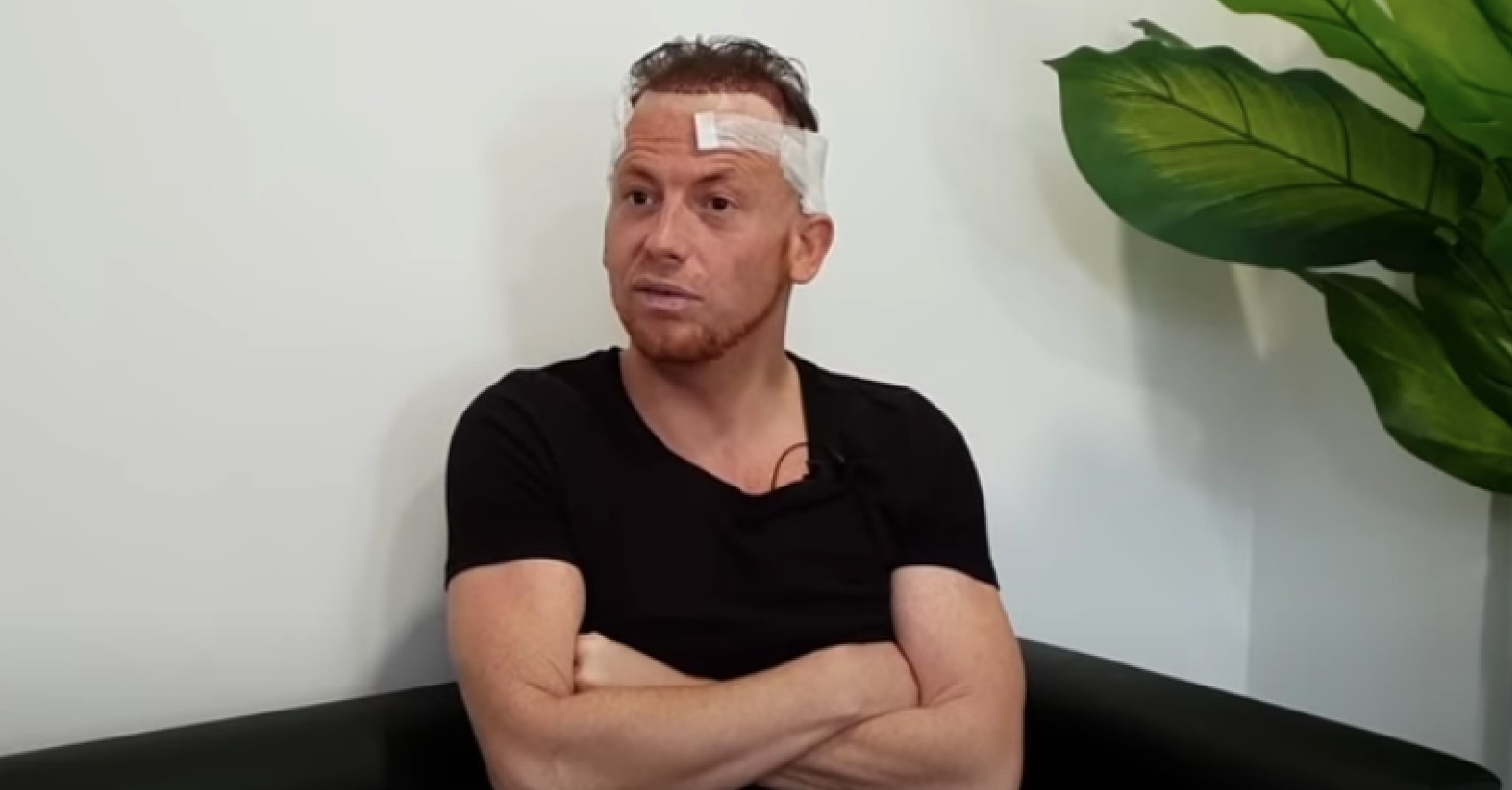 Joe Swash pictured after hair transplant