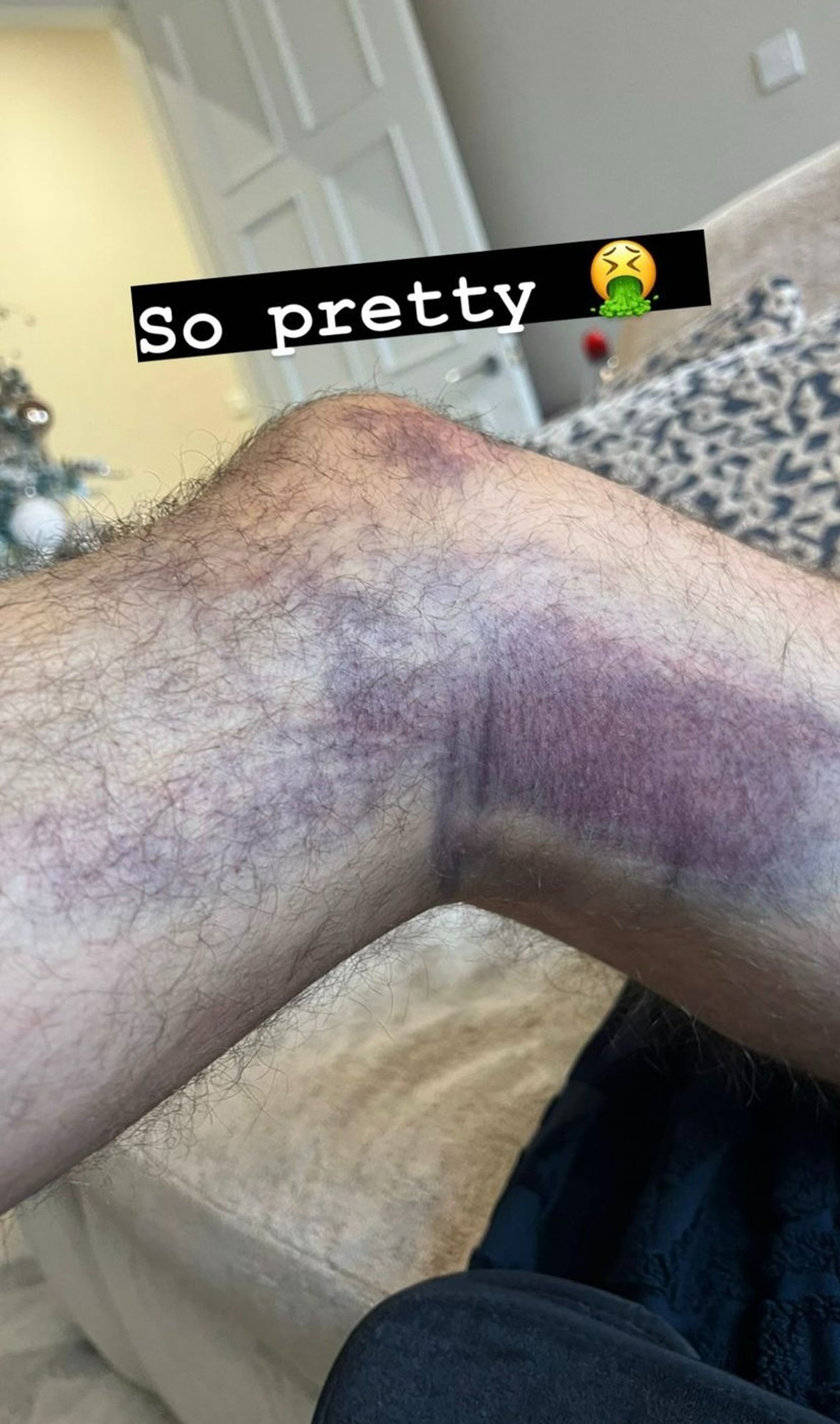 Gary Lucy's bruise on his legs