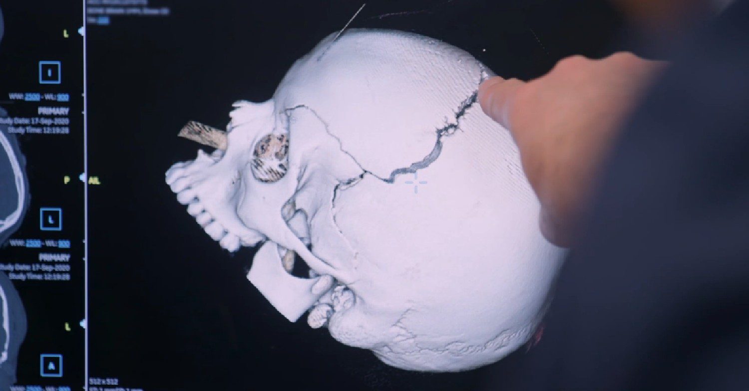 Skull fracture 