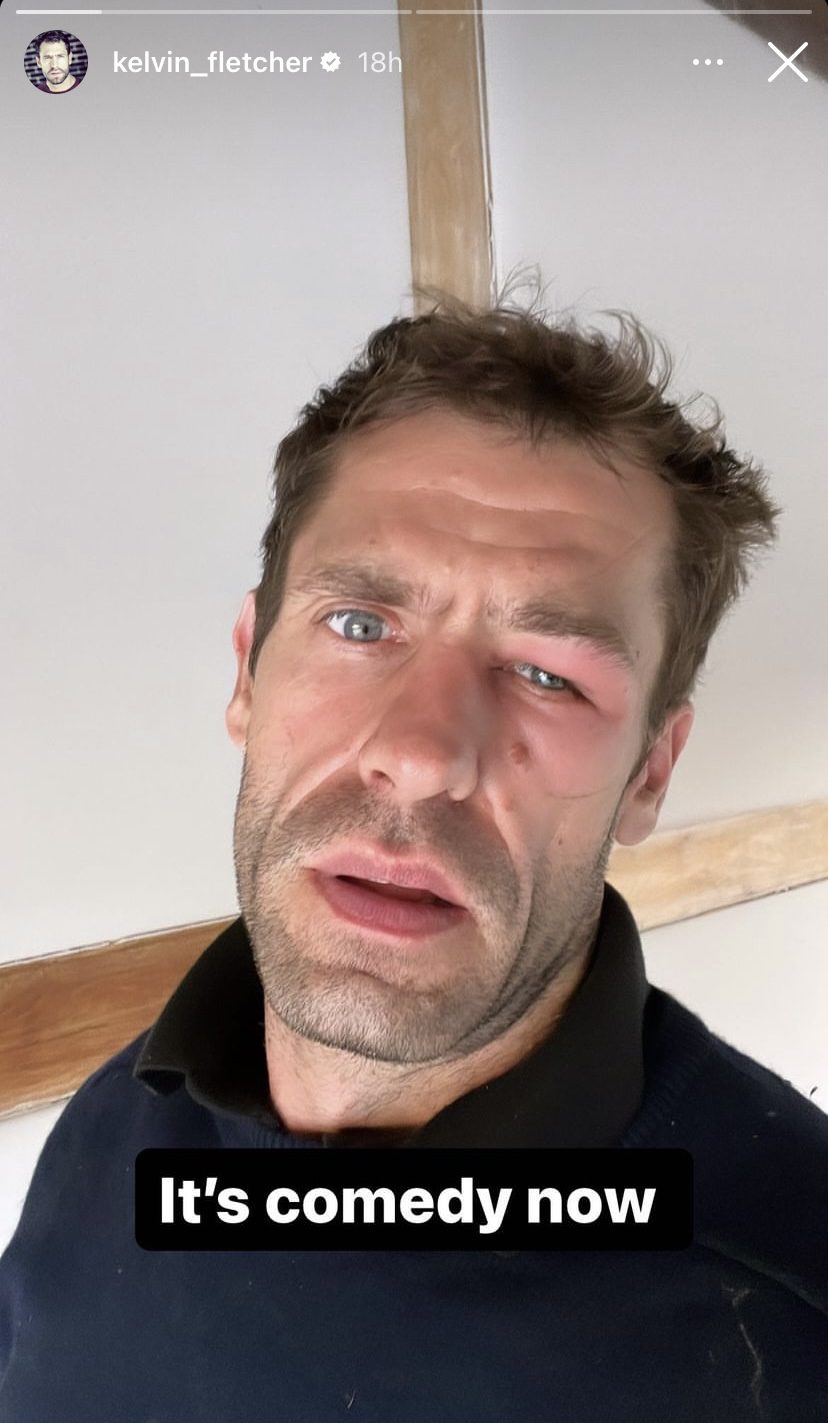 Actor Kelvin Fletcher's instagram story - a picture of him with a swollen face and the caption 'It's comedy now' 