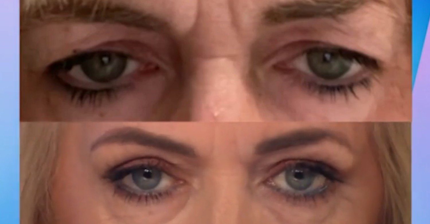 Before and after Jane Moore eye surgery