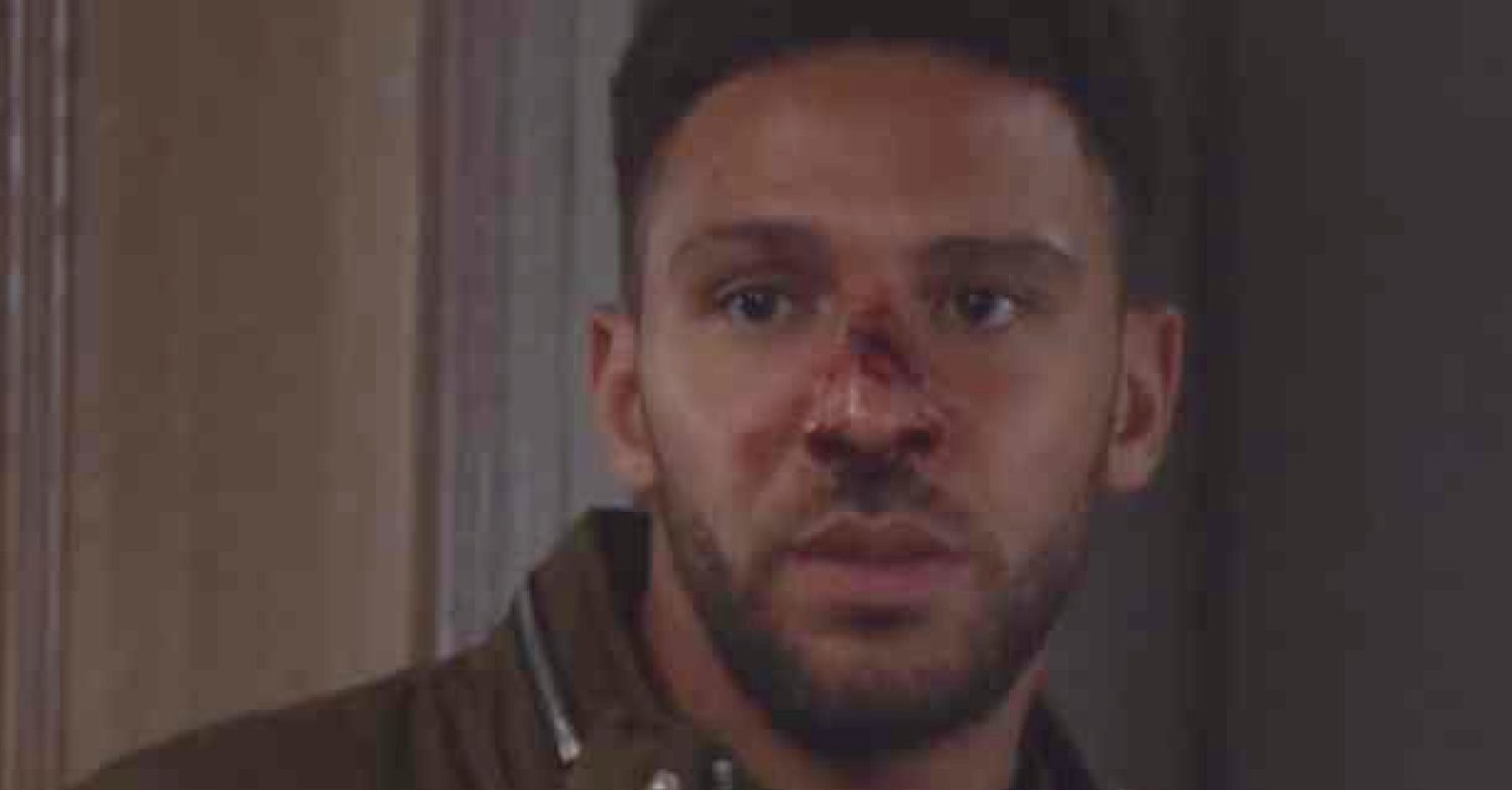 Emmerdale's Billy has a cut on his nose