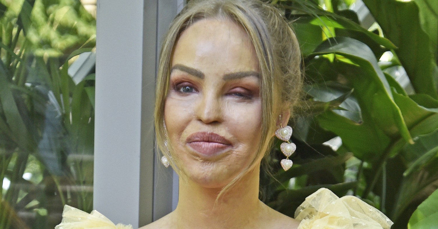 Katie Piper smiling in a yellow dress