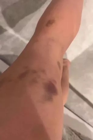 Laura Hamilton bruised leg