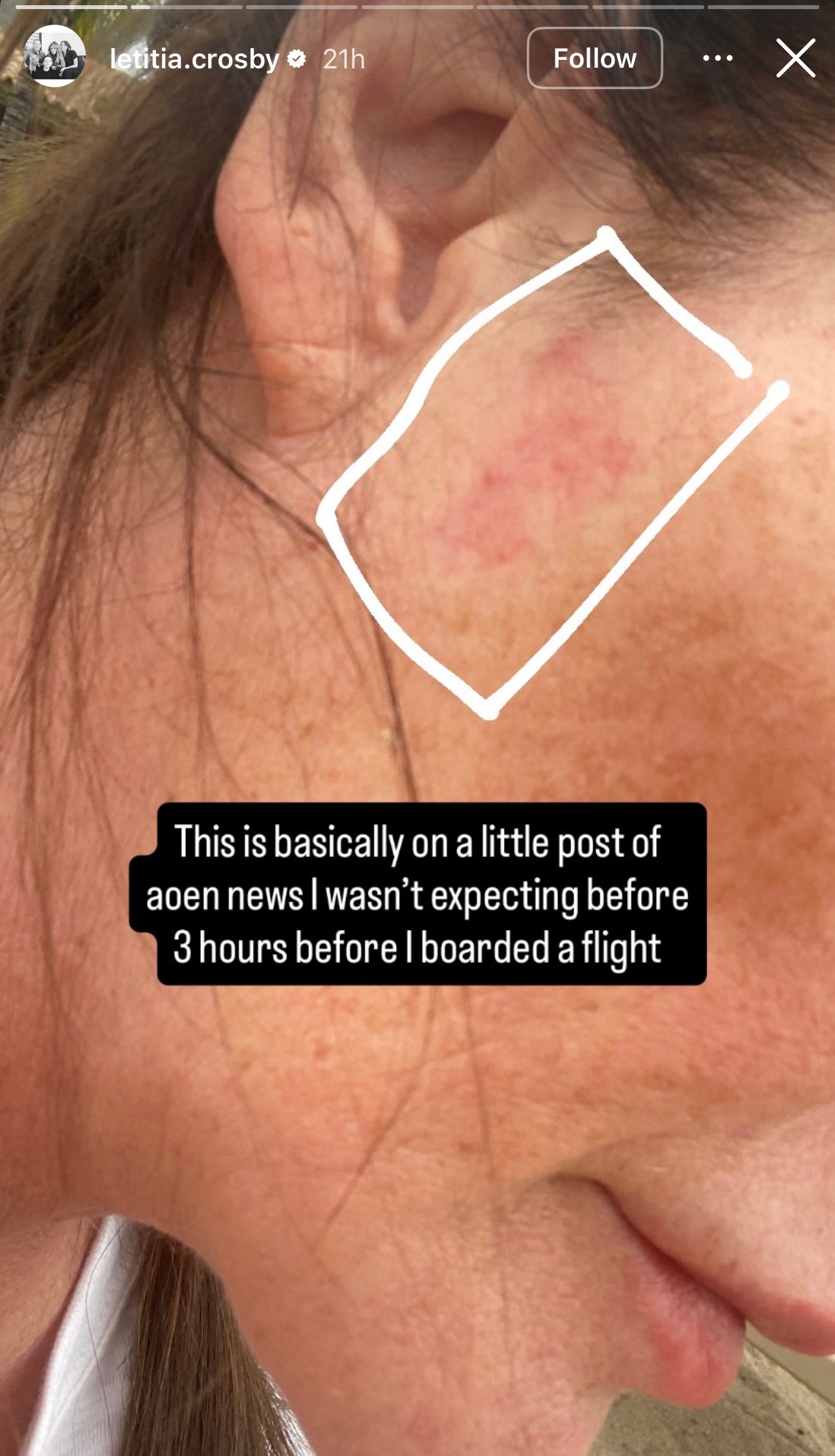 Letitia's cheek