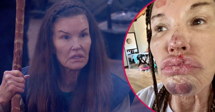 Janice Dickinson on I'm A Celebrity All Stars and her injuries