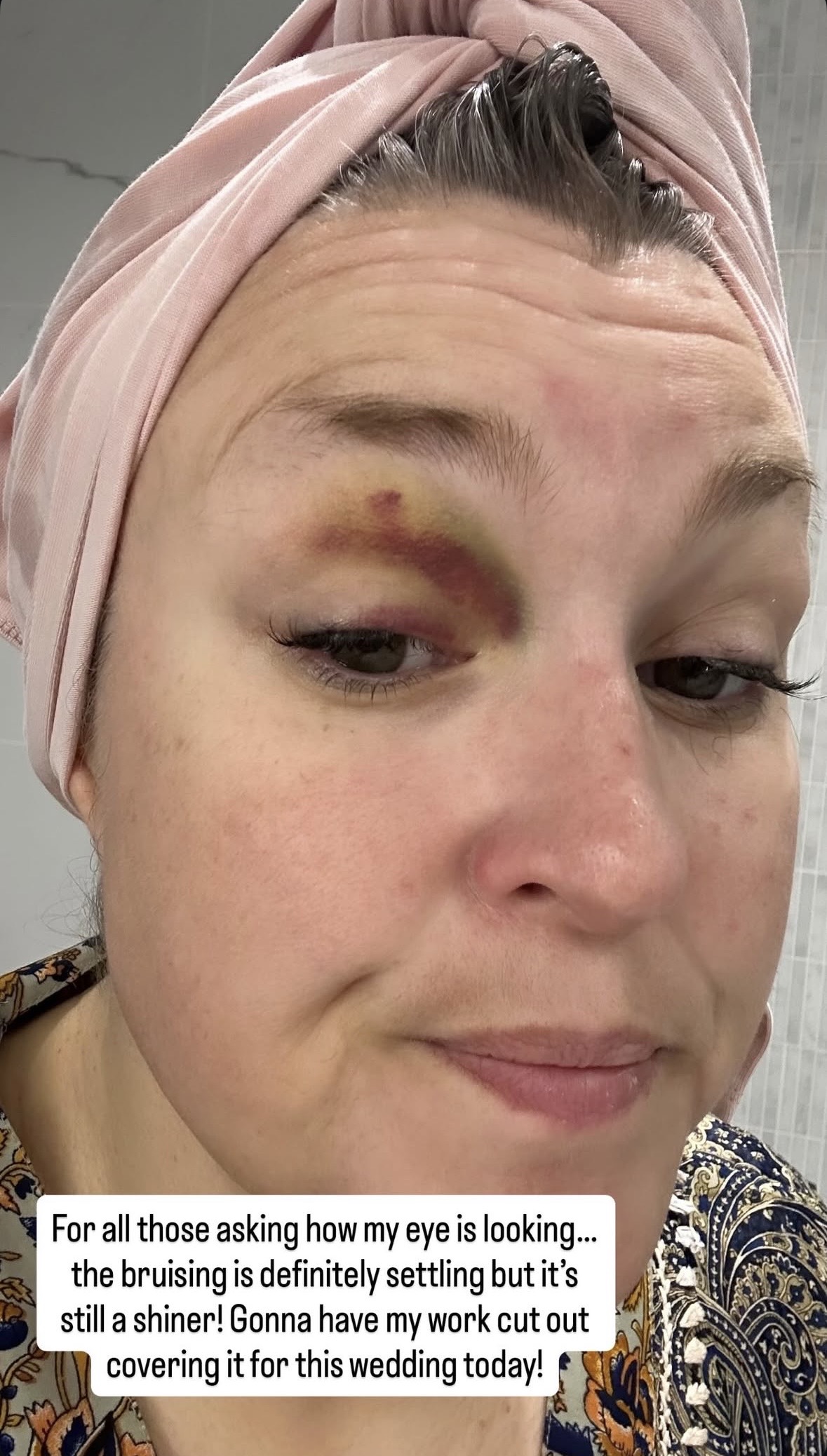 Sara Davies' black eye