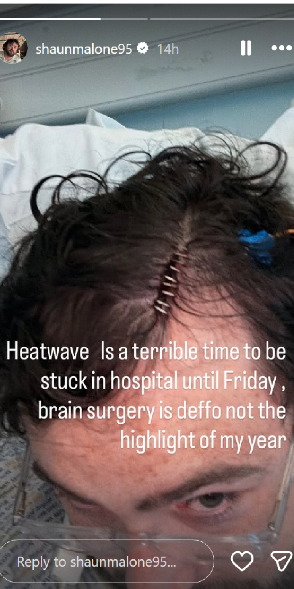 Shaun Malone reveals brain surgery scar