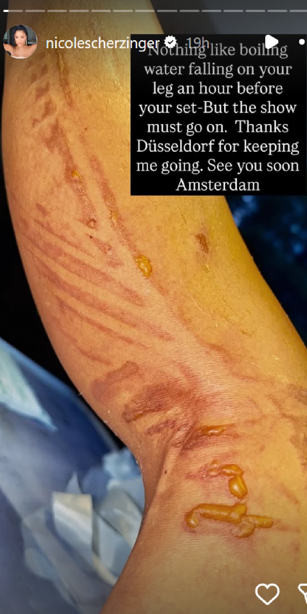 Nicole Scherzinger shows off burns from accident