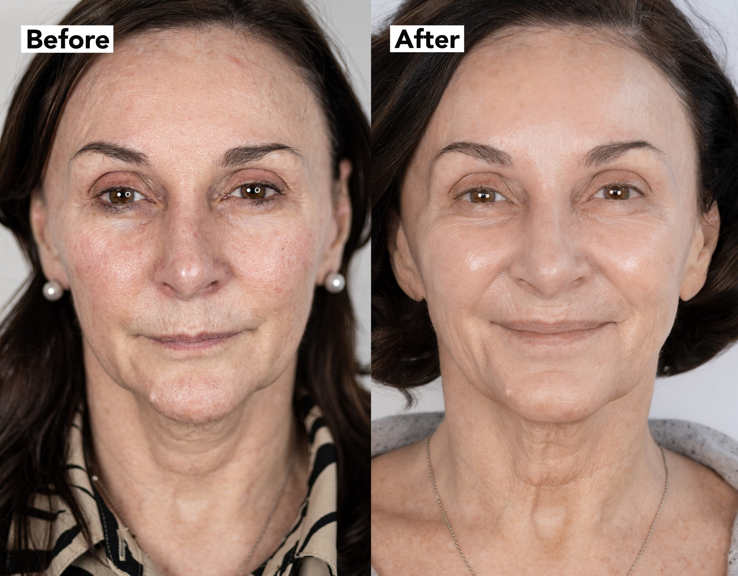 Before and after of Shirley Ballas face treatment