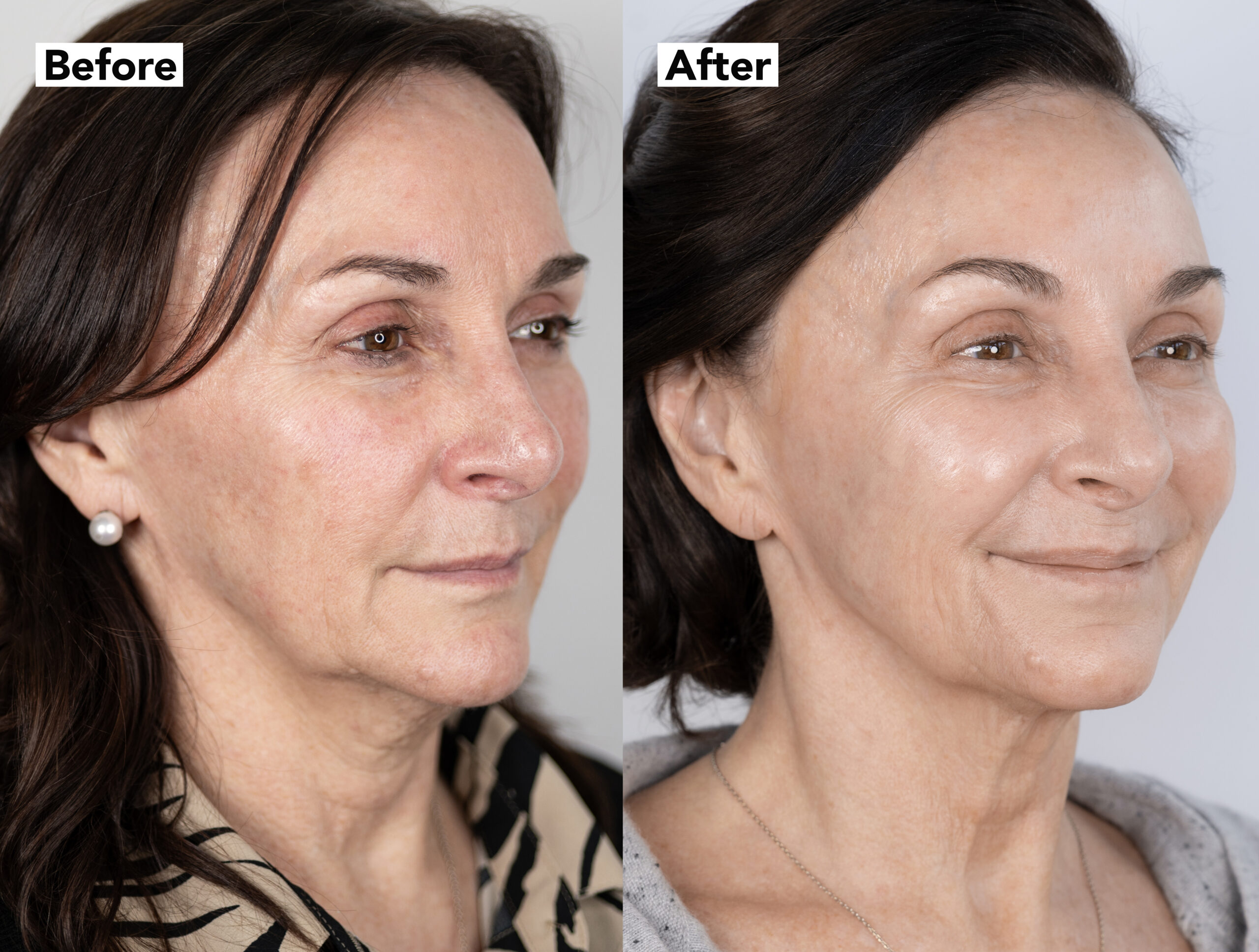 Before and after of Shirley Ballas face treatment