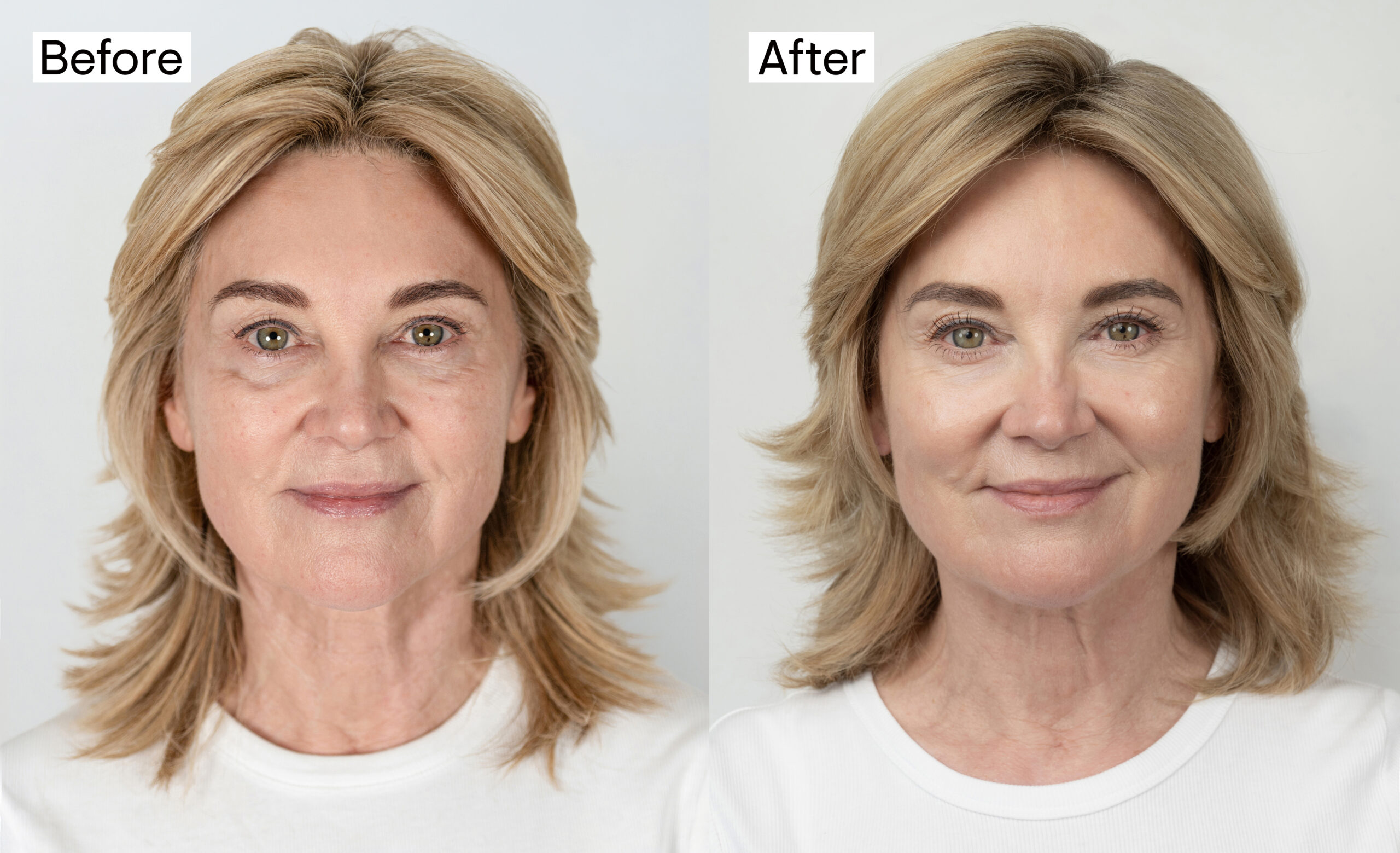 Anthea before and after her procedure