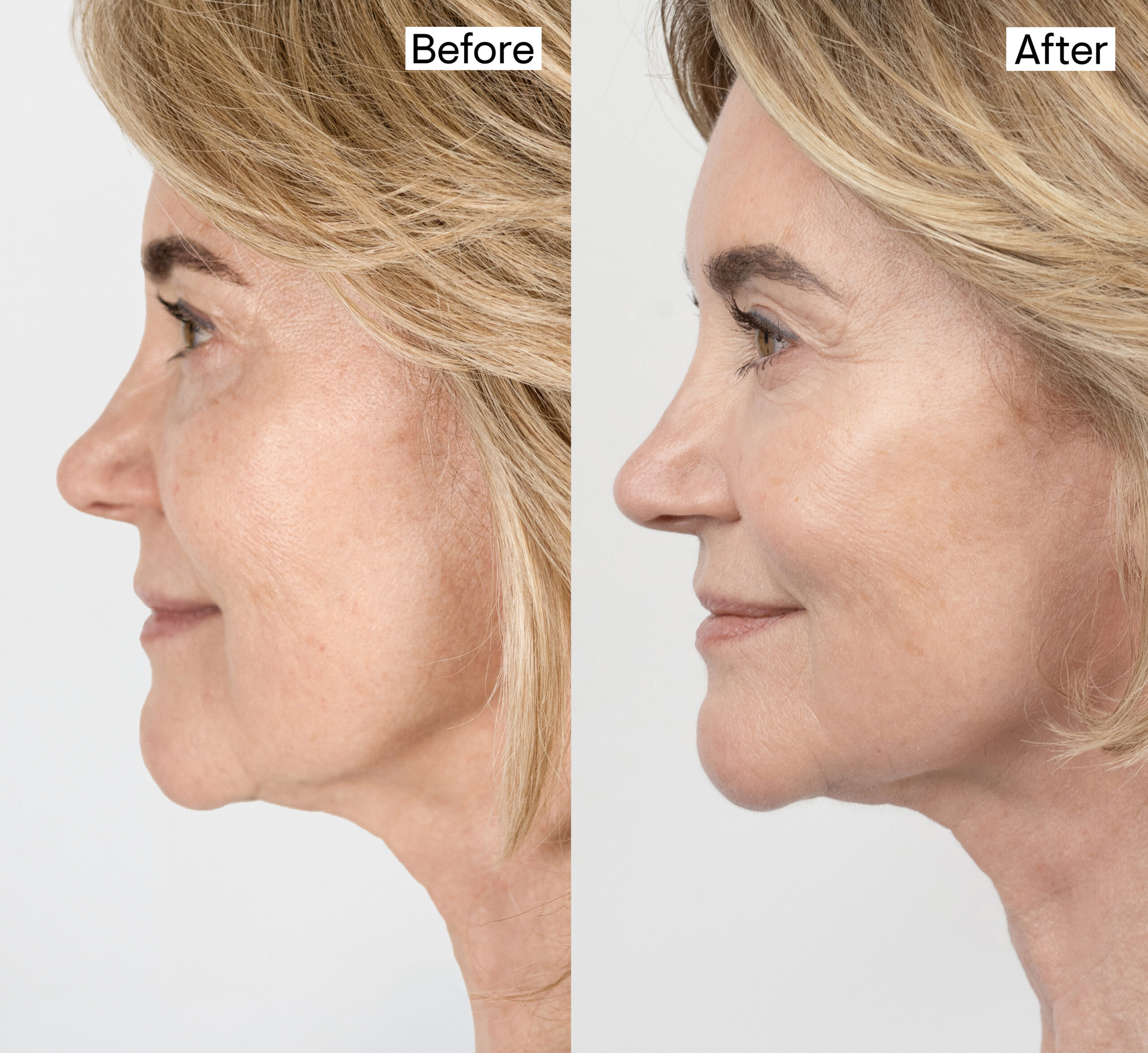 Anthea before and after her procedure
